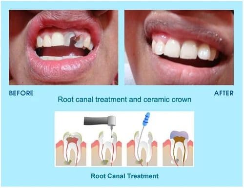 Before and after of a root canal treated tooth restored with a ceramic crown